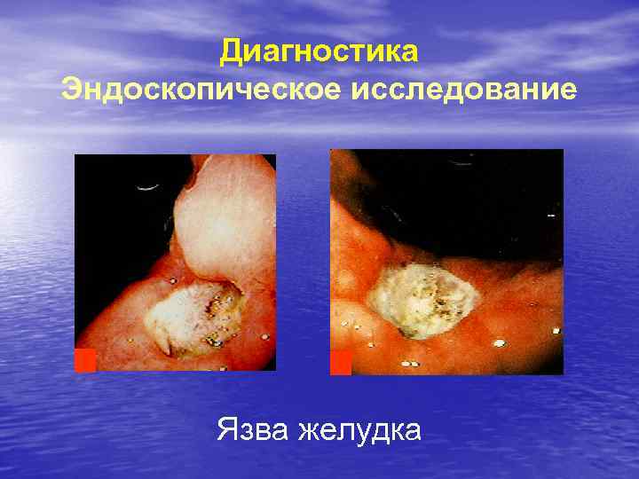 Диагностика Эндоскопическое исследование Язва желудка 