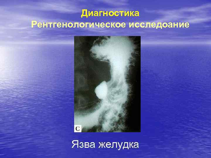 Диагностика Рентгенологическое исследоание Язва желудка 