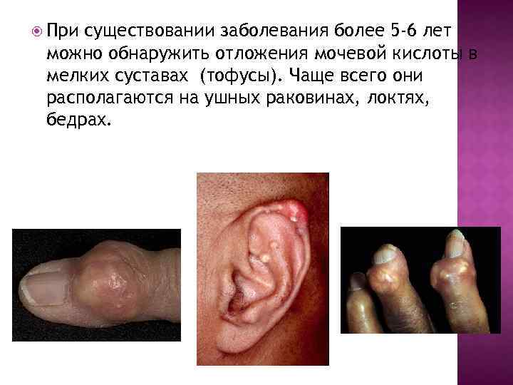  При существовании заболевания более 5 -6 лет можно обнаружить отложения мочевой кислоты в