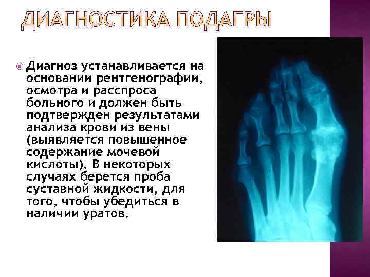  Диагноз устанавливается на основании рентгенографии, осмотра и расспроса больного и должен быть подтвержден