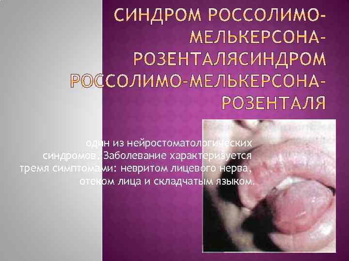 один из нейростоматологических синдромов. Заболевание характеризуется тремя симптомами: невритом лицевого нерва, отеком лица и