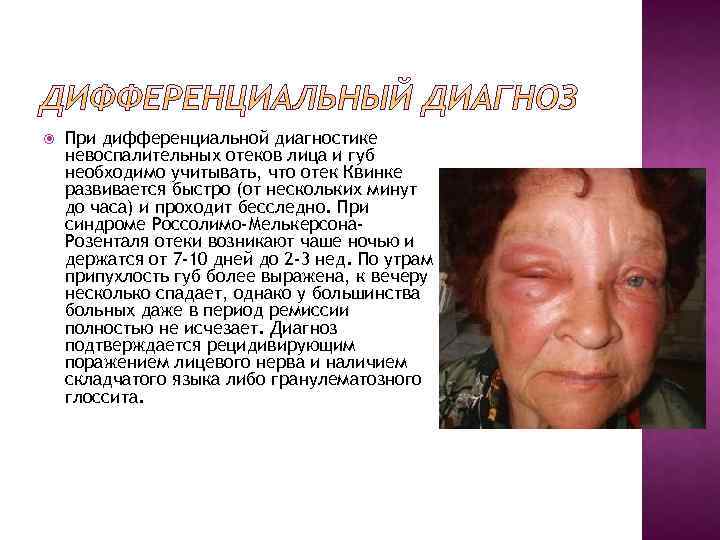  При дифференциальной диагностике невоспалительных отеков лица и губ необходимо учитывать, что отек Квинке