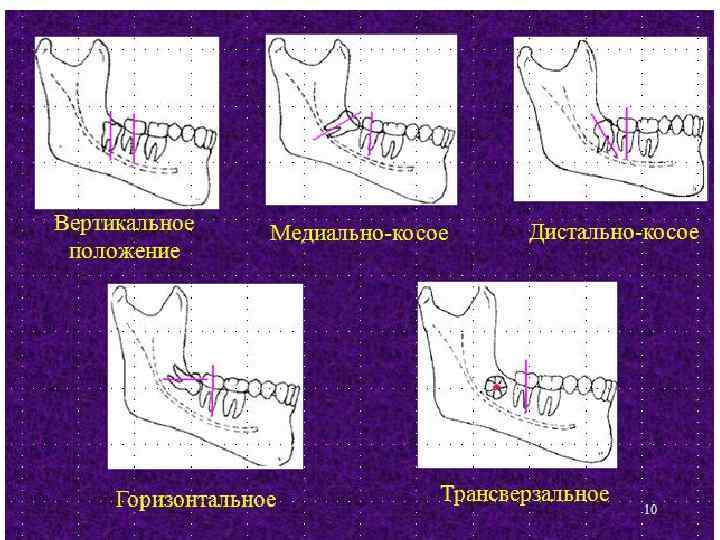 Синдром прорезывания зубов карта вызова скорой помощи