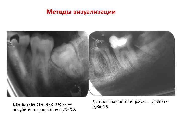 Болезни прорезывания зубов затрудненное прорезывание третьего нижнего моляра презентация