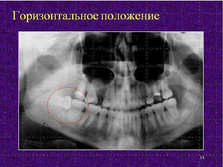 Стоматит на фоне прорезывания зубов