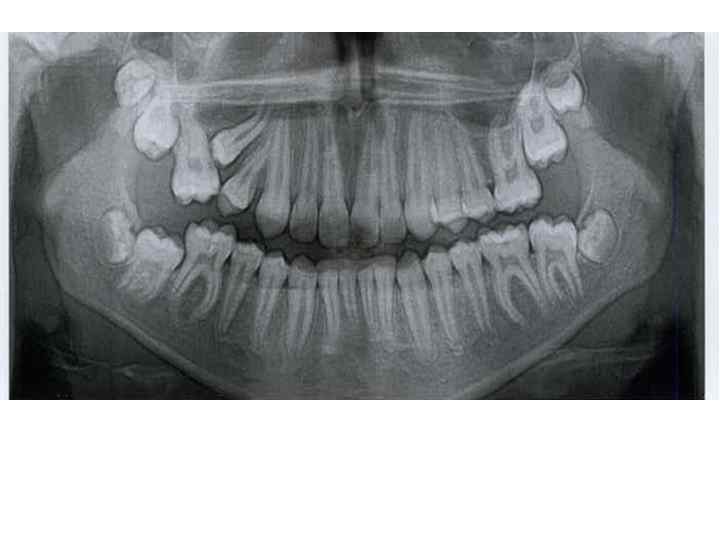 Ретенирование зуба. Ретинированный зуб мудрости рентген. Ретенированный клык рентген. Ретинированный зуб клык.