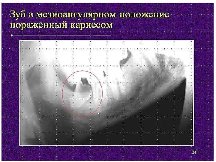 Стоматит на фоне прорезывания зубов