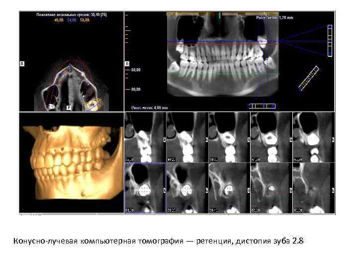 Клкт это. Ортопантомография — полуретенция, дистопия зуба 3.8. Ретенция и дистопия зуба.
