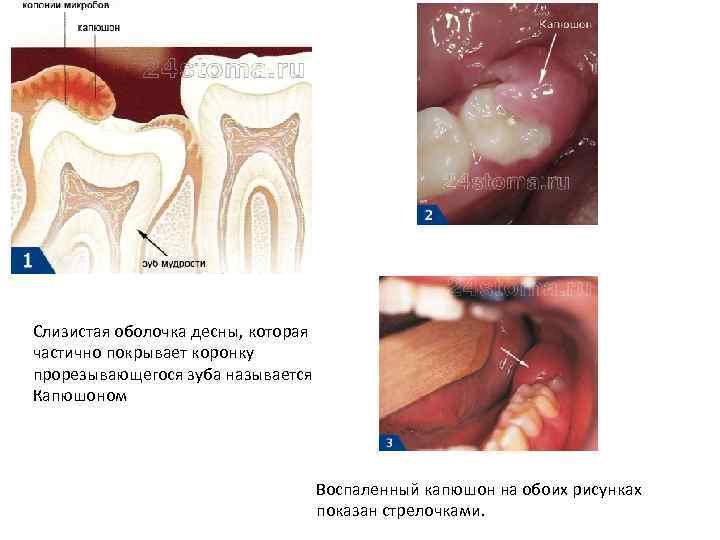 Слизистая оболочка десны, которая частично покрывает коронку прорезывающегося зуба называется Капюшоном Воспаленный капюшон на