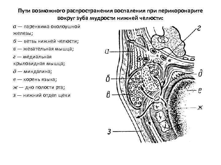 Пути возможного распространения воспаления при перикоронарите вокруг зуба мудрости нижней челюсти: а — паренхима