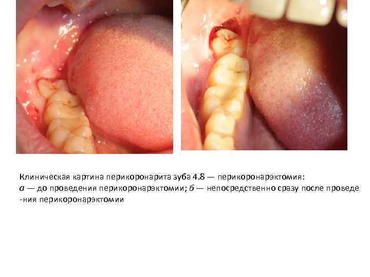 Клиническая картина перикоронарита зуба 4. 8 — перикоронарэктомия: а — до проведения перикоронарэктомии; б