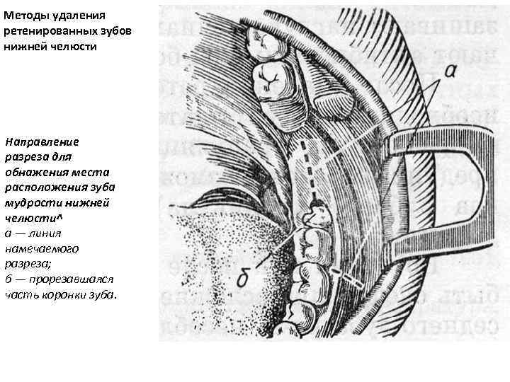 Методы удаления ретенированных зубов нижней челюсти Направление разреза для обнажения места расположения зуба мудрости