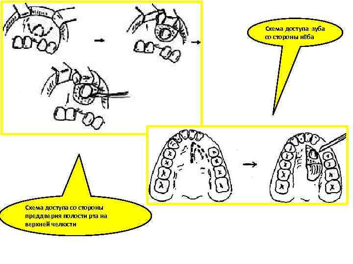 Схема доступа зуба со стороны нёба Схема доступа со стороны преддверия полости рта на