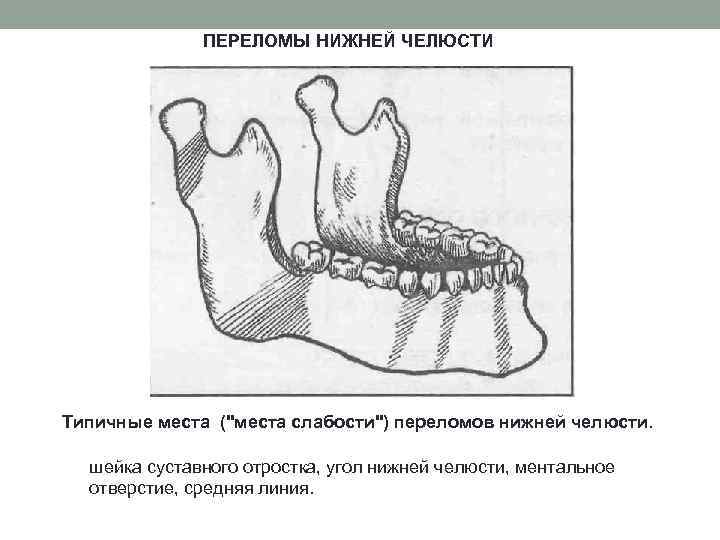 Перелом челюсти карта вызова