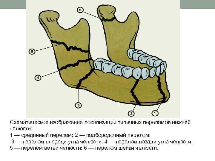 Клиническая картина при переломах нижней челюсти