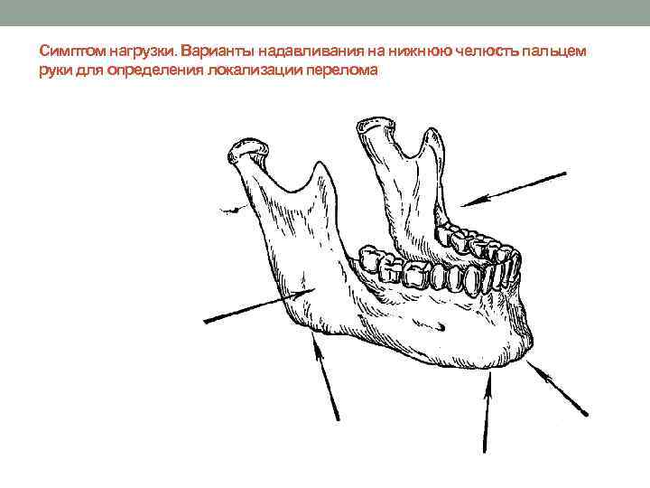 Перелом нижней челюсти карта вызова