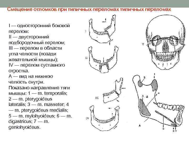 Смещение отломков при типичных переломах I — односторонний боковой перелом: II — двусторонний подбородочный