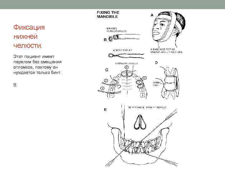 Фиксация нижней челюсти. Этот пациент имеет перелом без смещения отломков, поэтому он нуждается только