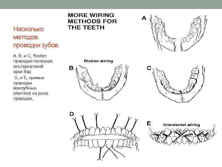 Несколько методов проводки зубов. A, B, и C, Risdon проводки полезной альтернативой арки бар.