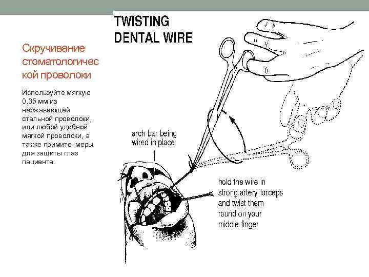 Скручивание стоматологичес кой проволоки Используйте мягкую 0, 35 мм из нержавеющей стальной проволоки, или
