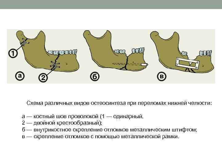 Перелом челюсти карта вызова