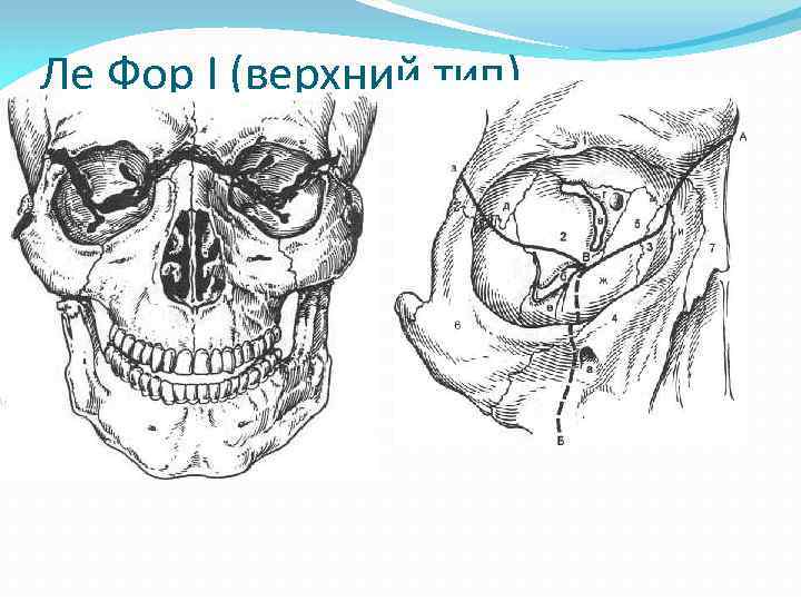 Ле Фор I (верхний тип) 