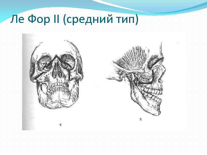 Ле Фор II (средний тип) 