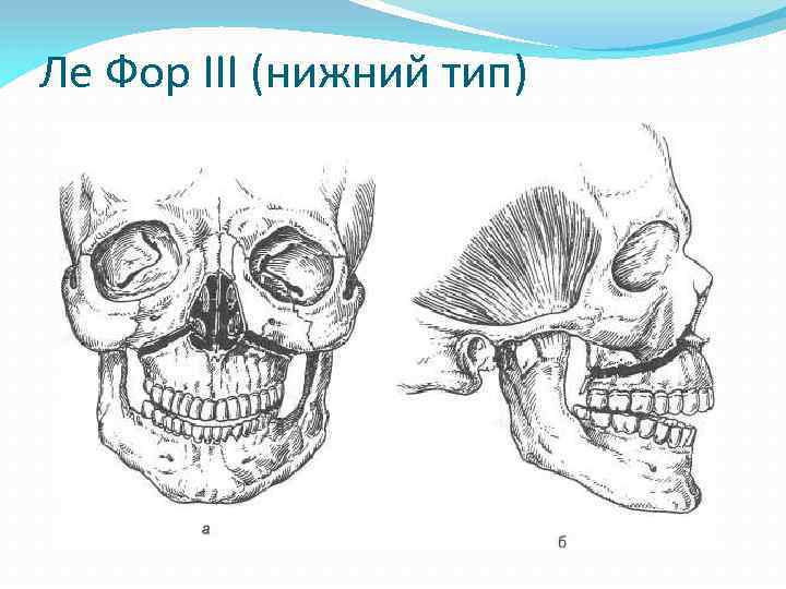 Ле Фор III (нижний тип) 