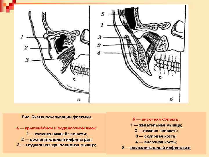 Рис. Схема локализации флегмон. а — крылонёбной и подвисочной ямок: 1 — головка нижней