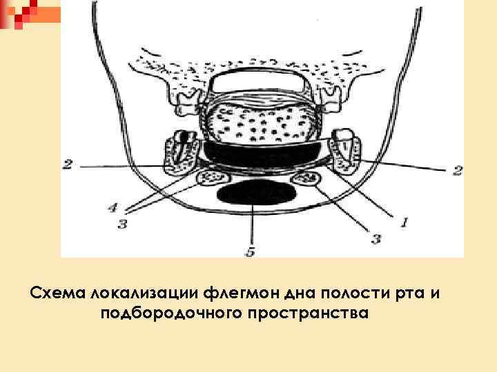 Схема локализации флегмон дна полости рта и подбородочного пространства 