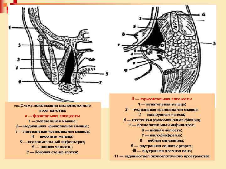 Рис. Схема локализации окологлоточного пространства: а — фронтальная плоскость: 1 — жевательная мышца; 2—