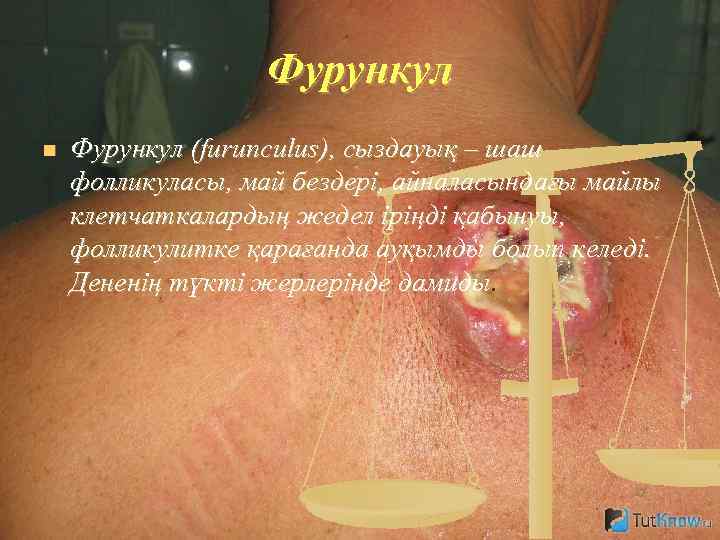 Фурункул n Фурункул (furunculus), сыздауық – шаш фолликуласы, май бездері, айналасындағы майлы клетчаткалардың жедел