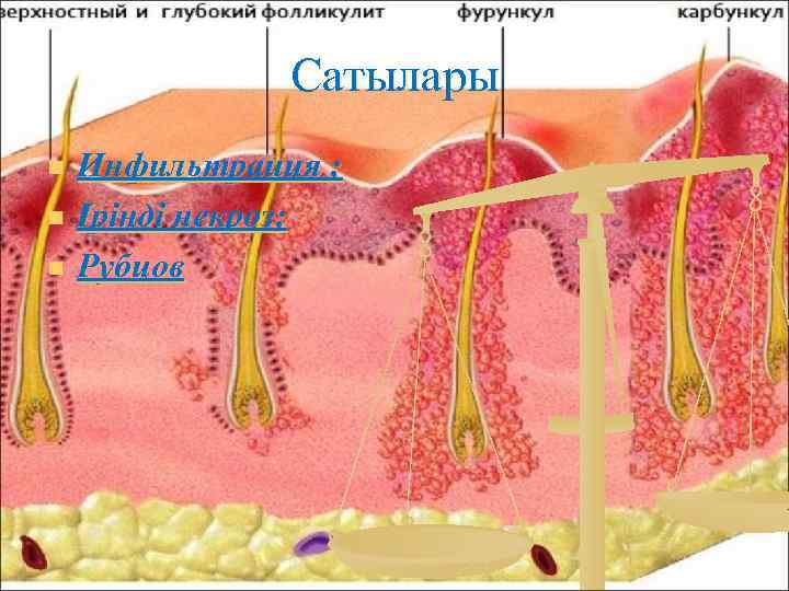 Сатылары n n n Инфильтрация ; Іріңді некроз; Рубцов 