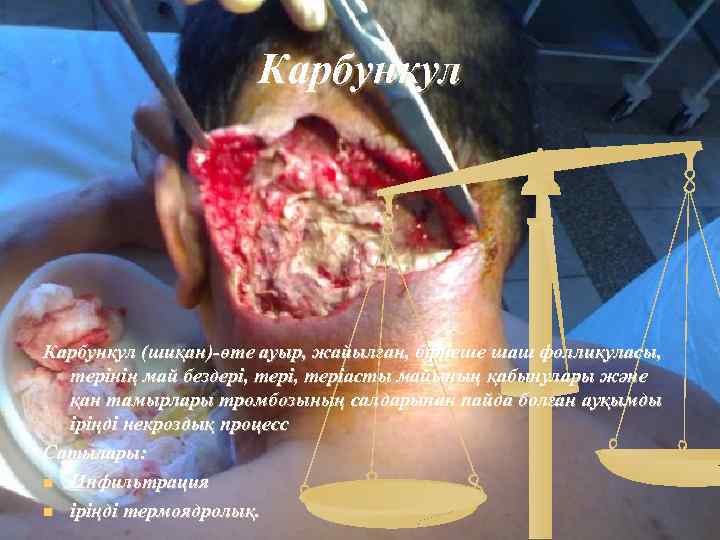 Карбункул (шиқан)-өте ауыр, жайылған, бірнеше шаш фолликуласы, терінің май бездері, теріасты майының қабынулары және