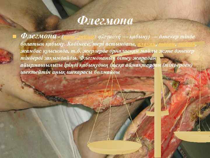 Флегмона n Флегмона - (көне грекше: φλεγμονή — қабыну) — дәнекер тінде болатын қабыну.