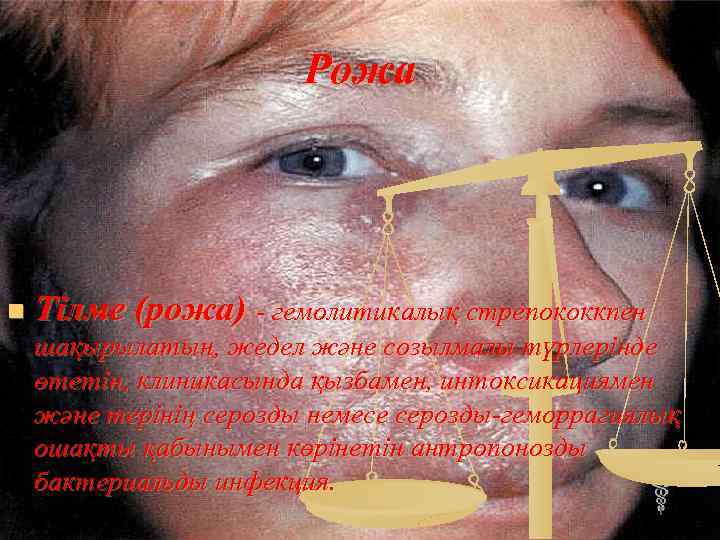 Рожа n Тілме (рожа) - гемолитикалық стрепококкпен шақырылатын, жедел және созылмалы түрлерінде өтетін, клиникасында