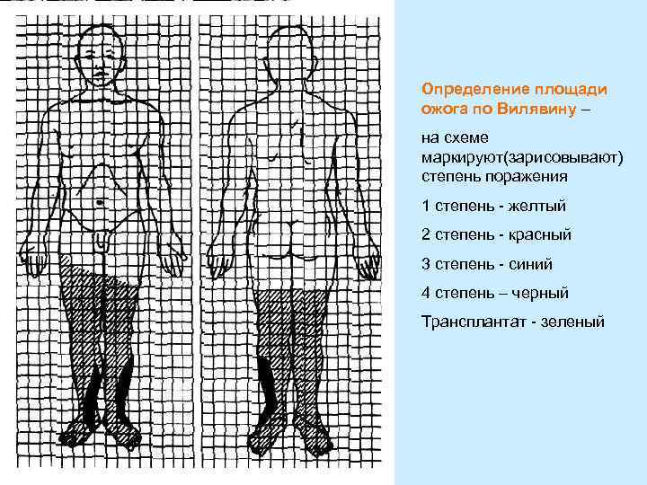 Определение площади ожога по Вилявину – на схеме маркируют(зарисовывают) степень поражения 1 степень -