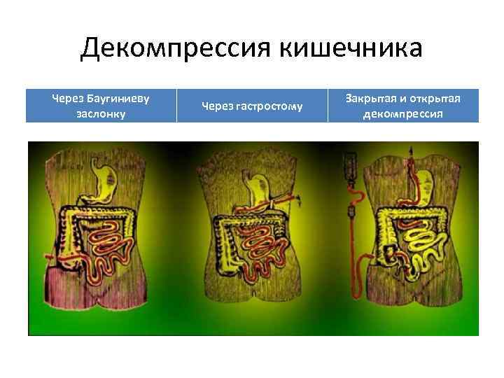 Декомпрессия кишечника Через Баугиниеву заслонку Через гастростому Закрытая и открытая декомпрессия 