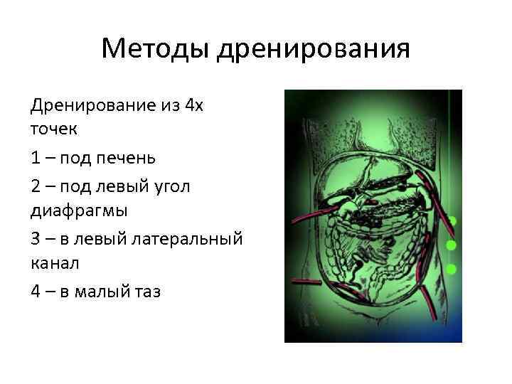 Методы дренирования Дренирование из 4 х точек 1 – под печень 2 – под