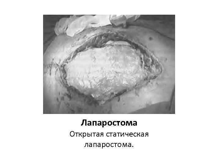 Лапаростома Открытая статическая лапаростома. 