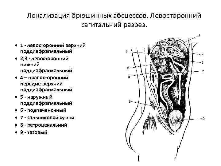 Локализация брюшинных абсцессов. Левосторонний сагитальний разрез. · 1 - левосторонний верхний поддиафрагмальный · 2,