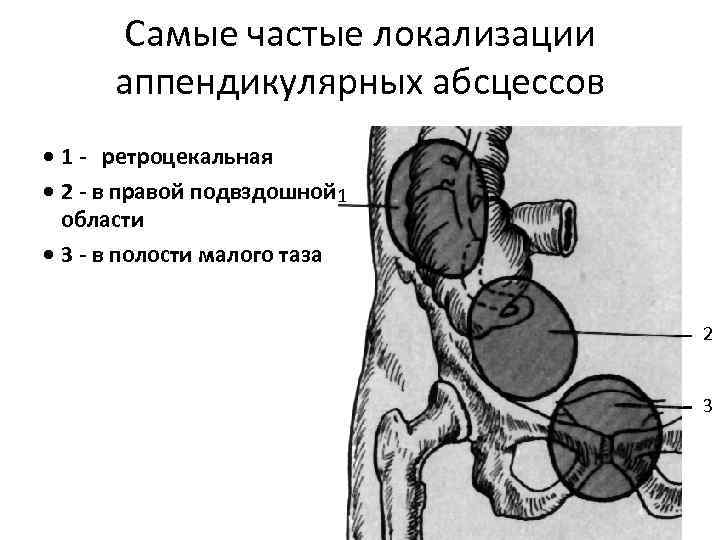 Наиболее частой локализацией