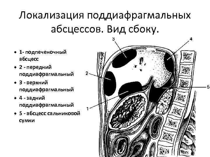 Схема формирования сальниковой сумки