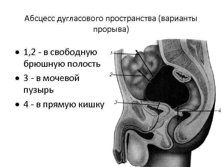 Абсцесс дугласового пространства (варианты прорыва) · 1, 2 - в свободную брюшную полость ·