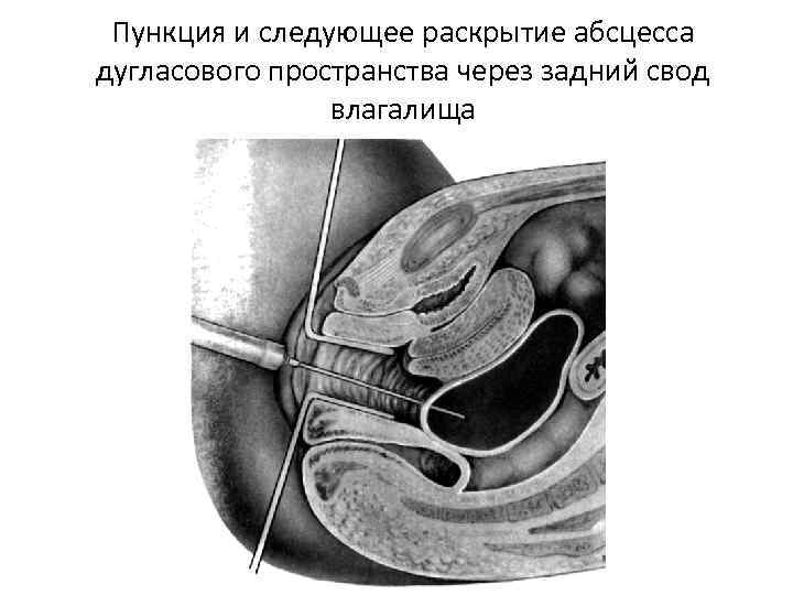 Пункция и следующее раскрытие абсцесса дугласового пространства через задний свод влагалища 