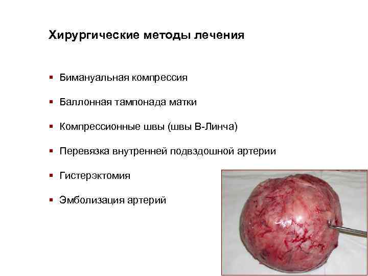 Хирургические методы лечения § Бимануальная компрессия § Баллонная тампонада матки § Компрессионные швы (швы