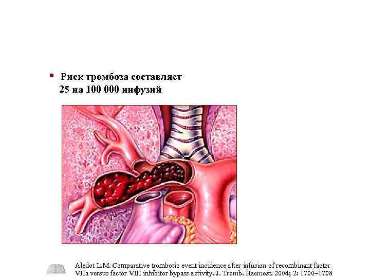 § Риск тромбоза составляет 25 на 100 000 инфузий Aledot L. M. Comparative trombotic