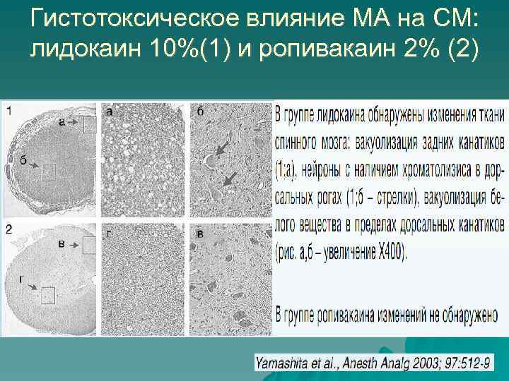 Гистотоксическое влияние МА на СМ: лидокаин 10%(1) и ропивакаин 2% (2) 