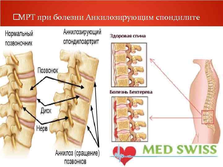  МРТ при болезни Анкилозирующим спондилите 