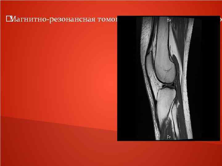  Магнитно-резонансная томография коленного сустава по 